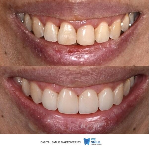 รอยยิ้มก่อนและหลังทำ Digital Smile Makeover เคสที่ 6