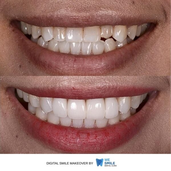รอยยิ้มก่อนและหลังทำ Digital Smile Makeover เคสที่ 7