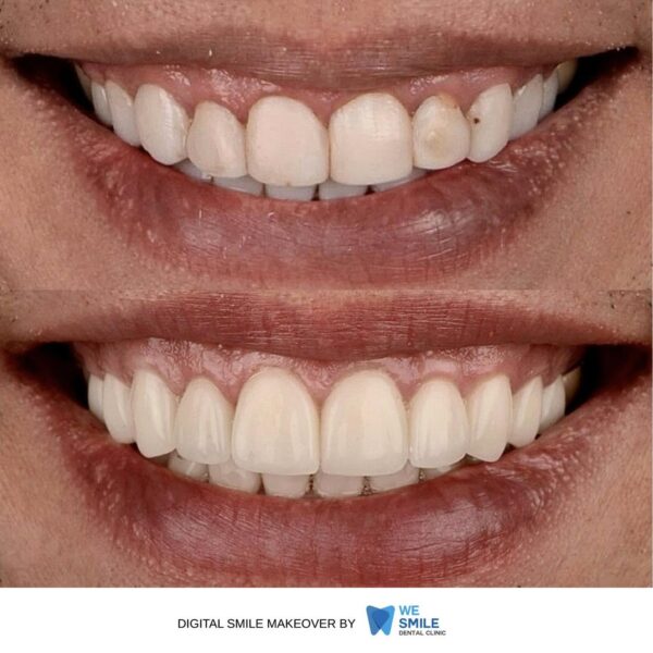 รอยยิ้มก่อนและหลังทำ Digital Smile Makeover เคสที่ 8