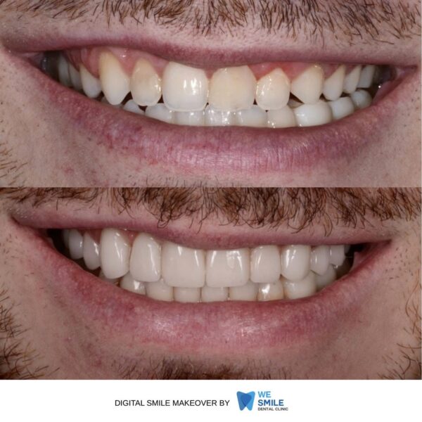 รอยยิ้มก่อนและหลังทำ Digital Smile Makeover เคสที่ 9
