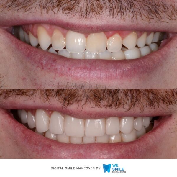 รอยยิ้มก่อนและหลังทำ Digital Smile Makeover เคสที่ 10