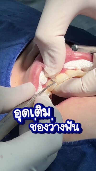 อุดเติมช่องว่างระหว่างฟัน