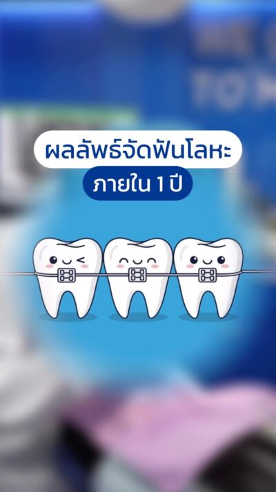 จากฟันเรียงไม่สวย สู่รอยยิ้มมั่นใจใน 1 ปี