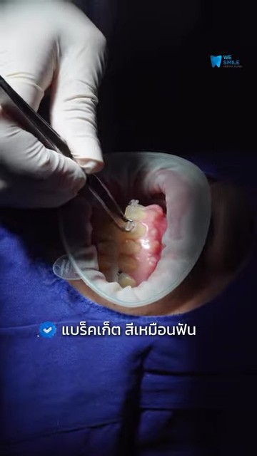 อยากจัดฟัน แต่ไม่อยากให้เห็นเครื่องมือชัด