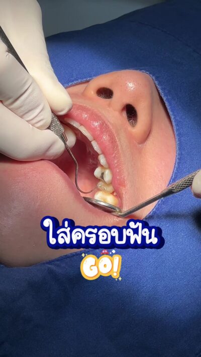 ครอบฟันสวยเนียนเหมือนฟันธรรมชาติ