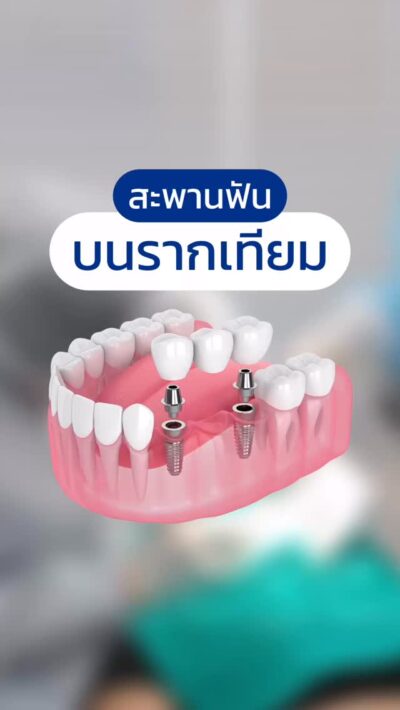 ฟันหน้าหาย 2 ซี่ รากฟันเทียมร่วมกับสะพานฟัน