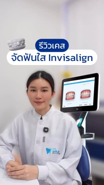 ฟันล่างคร่อมฟันบน สู่รอยยิ้มใหม่ด้วย Invisalign