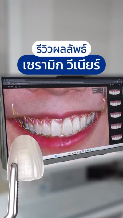 ออกแบบรอยยิ้มใหม่ด้วยเซรามิกวีเนียร์