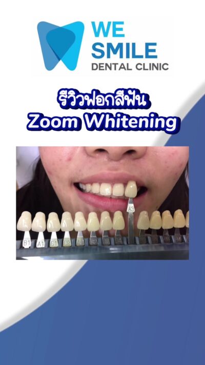 ฟอกสีฟัน Philips Zoom ใช้เวลาประมาณ 45 นาที