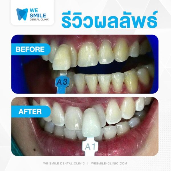 ผลฟอกสีฟัน Cool Light (Pola Whitening) ก่อนและหลัง