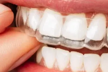 ภาพประกอบจัดฟันใส Invisalign ชิ้นงานใสแบบถอดได้