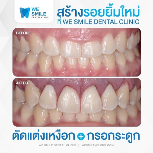 ผลตัดแต่งเหงือกพร้อมกรอกระดูกฟันหน้าก่อนและหลัง