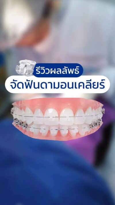 รีวิวผลลัพธ์จัดฟันดามอนเคลียร์