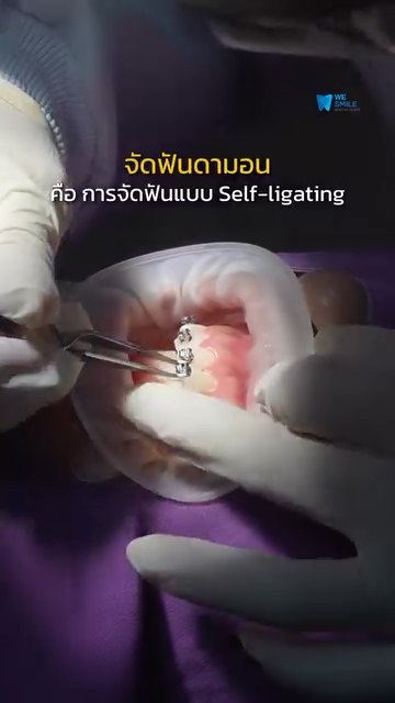 จัดฟันดามอน ทางเลือกของคนอยากจัดฟันแบบสบายขึ้น