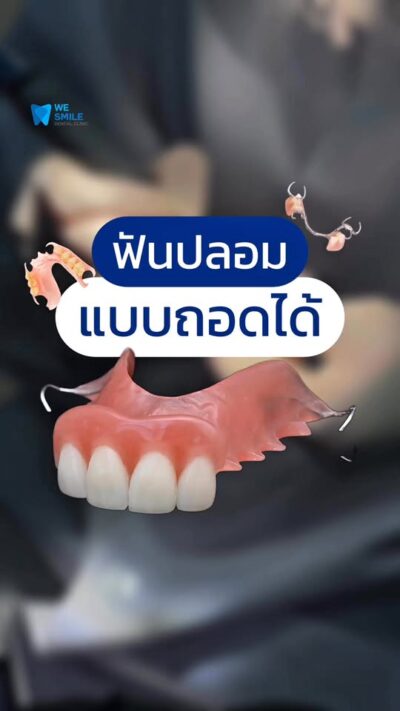 คลิปฟันปลอมแบบถอดได้