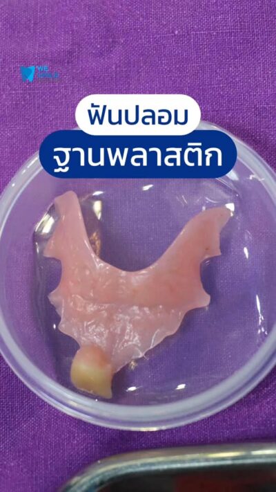 คลิปฟันปลอมฐานพลาสติก