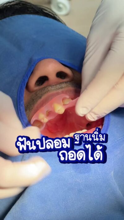 คลิปฟันปลอมฐานนิ่ม ถอดได้