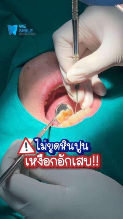 คลิปไม่ขูดหินปูน เสี่ยงเหงือกอักเสบ