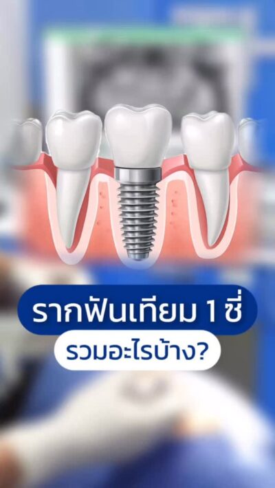 รากฟันเทียม 1 ซี่ รวมอะไรบ้าง