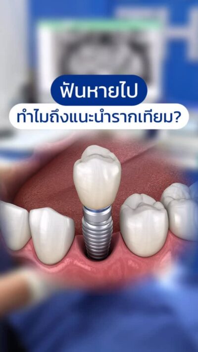 ฟันหายไป ทำไมถึงแนะนำรากเทียม