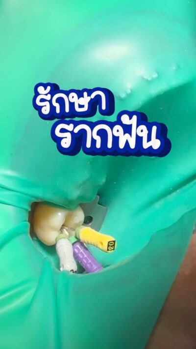 คลิปขั้นตอนการรักษารากฟัน